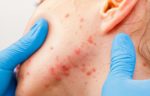 Tazarotene